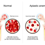 hypoplastic anemia