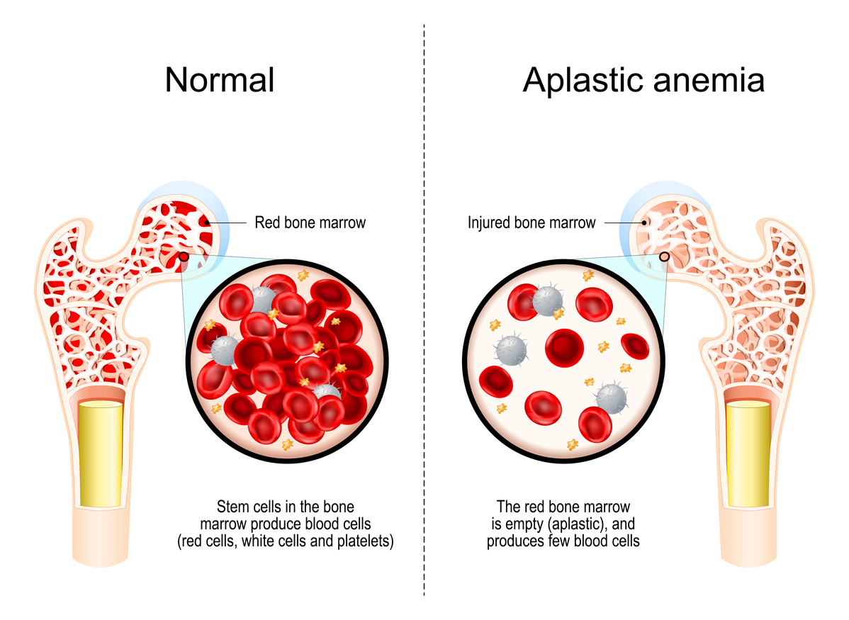 hypoplastic anemia