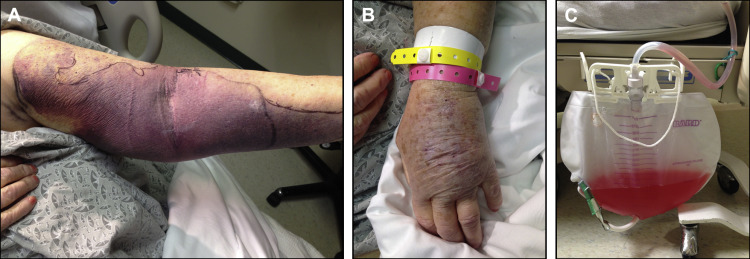 hypoprothrombinemia