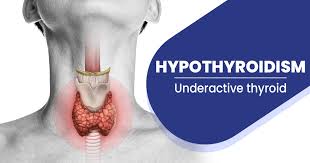 hypothyroidism