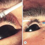 hypotrichosis of eyelid lashes