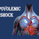 hypovolemic shock