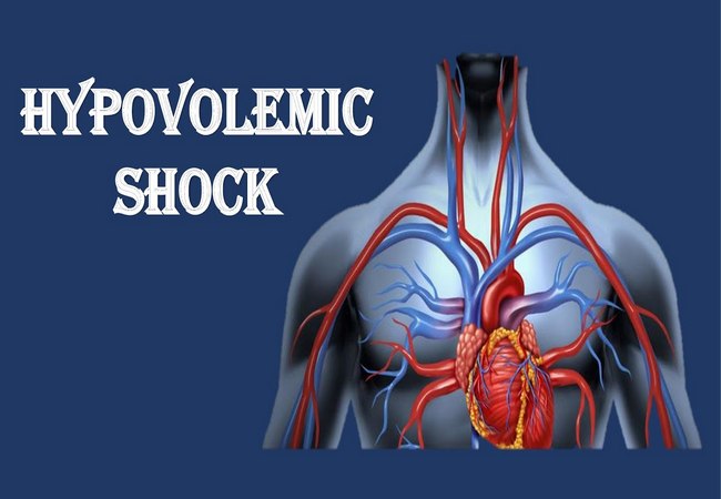 hypovolemic shock