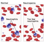 idiopathic neutropenia