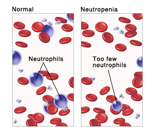 idiopathic neutropenia