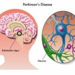 idiopathic parkinsonism