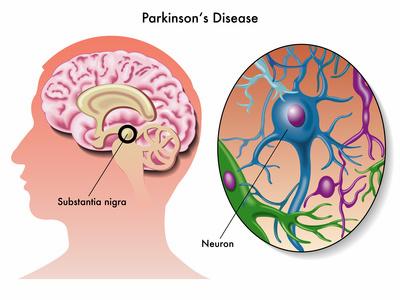 idiopathic parkinsonism