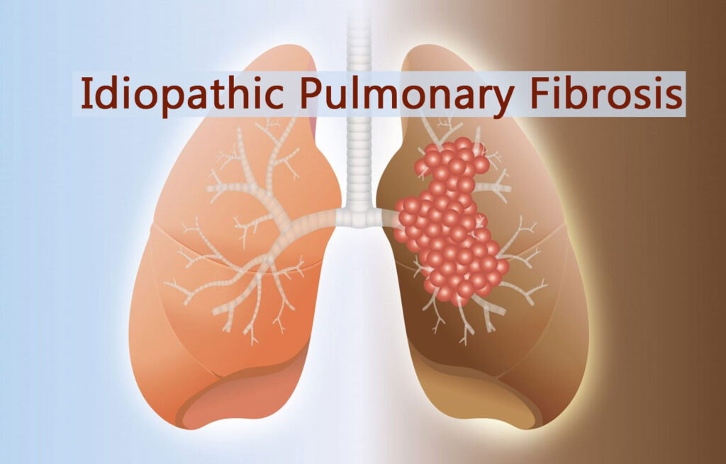 idiopathic pulmonary fibrosis