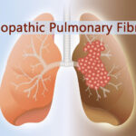 idiopathic pulmonary fibrosis