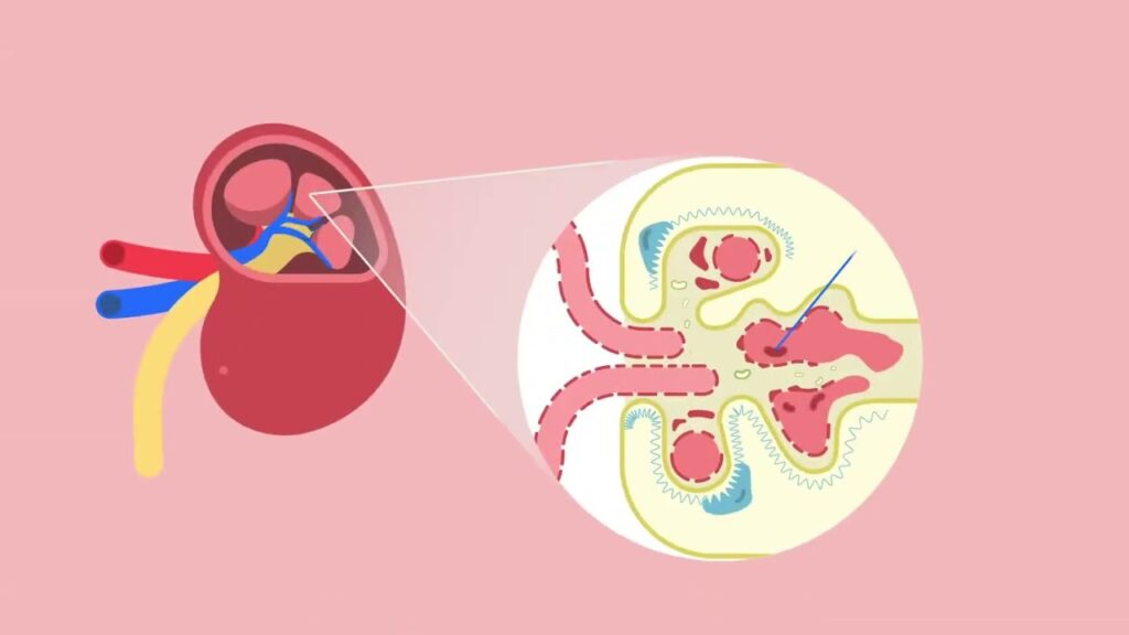 immunoglobulin a nephropathy