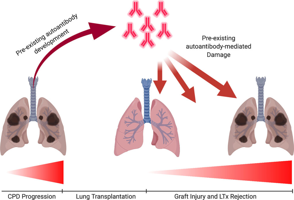 immunosuppression therapy for lung transplant