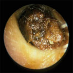 impacted cerumen