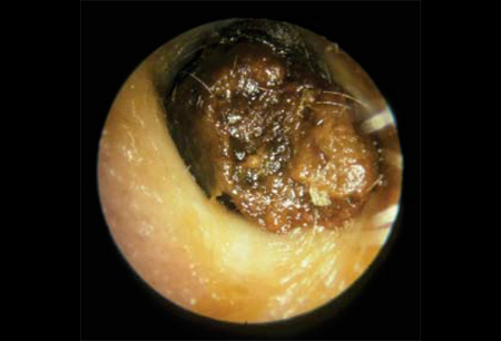 impacted cerumen