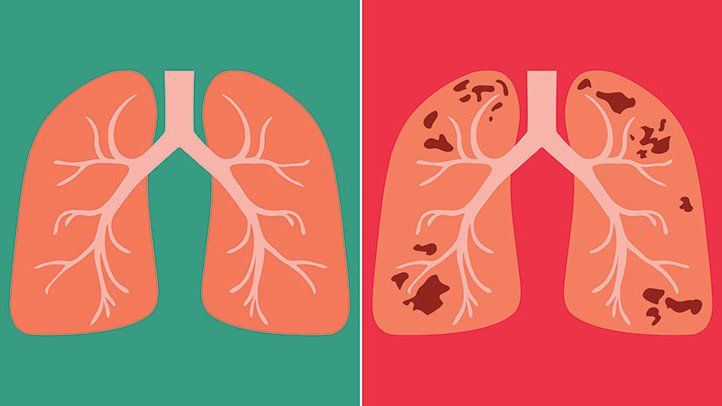 inactive tuberculosis