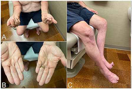 inclusion body myositis