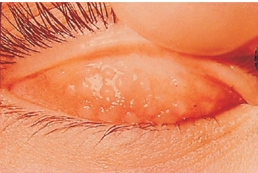 inclusion conjunctivitis caused by chlamydia trachomatis