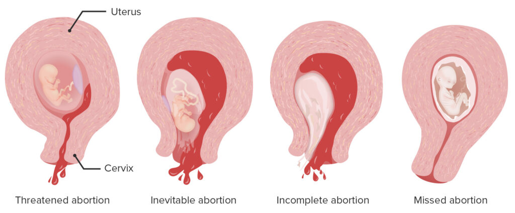 incomplete abortion