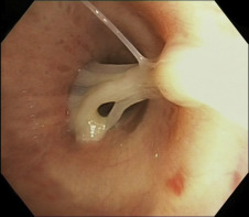 increased bronchial secretions