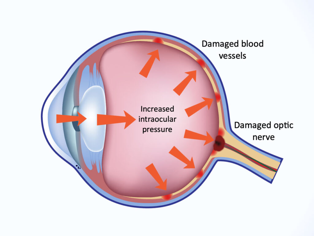 increased intraocular pressure after ocular procedure