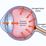 increased intraocular pressure after ocular procedure