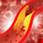 increased risk of atherosclerotic cardiovascular disease