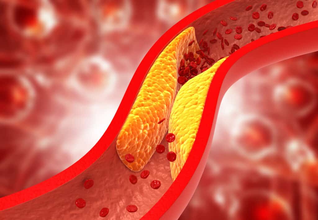 increased risk of atherosclerotic cardiovascular disease