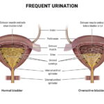 increased urinary frequency