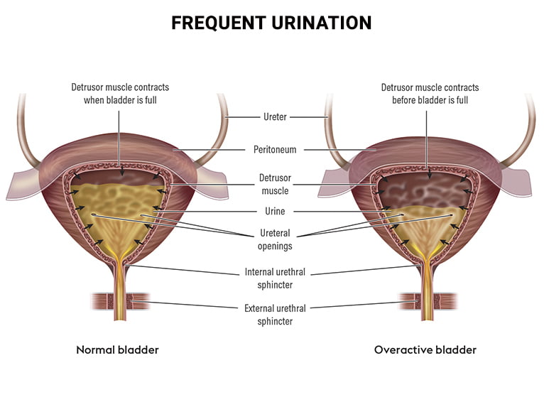 increased urinary frequency