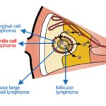 indolent b-cell non-hodgkin lymphoma