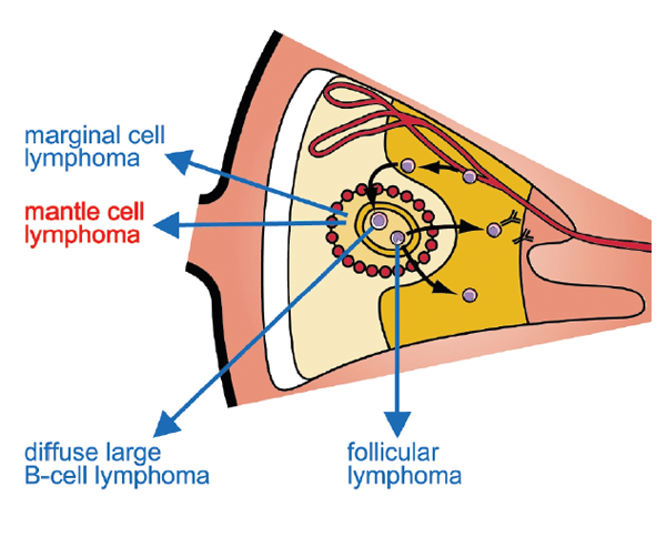 indolent b-cell non-hodgkin lymphoma