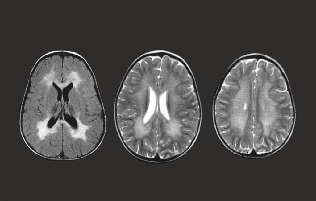 infantile metachromatic leukodystrophy