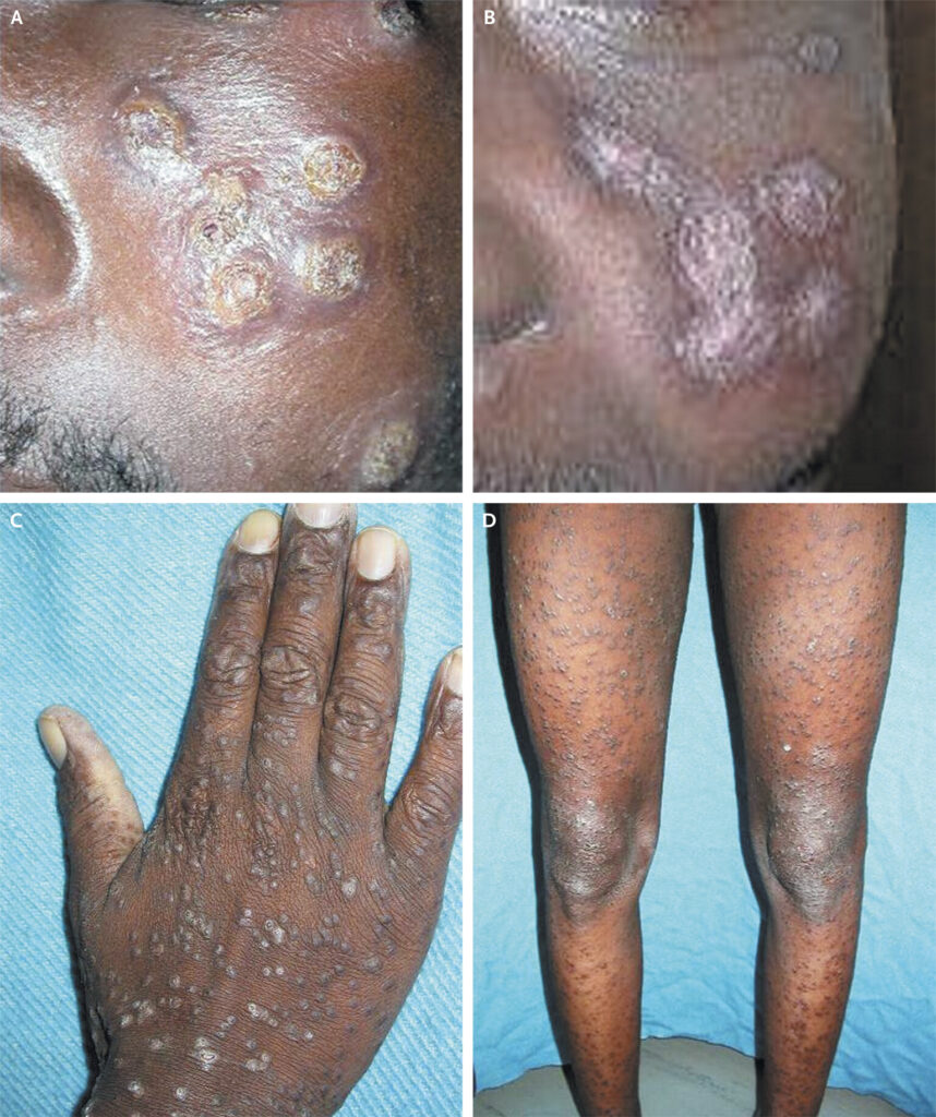 infection due to penicillium marneffei