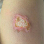 infection of burn wound