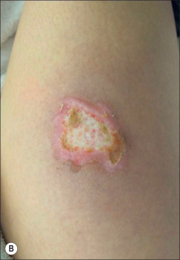 infection of burn wound