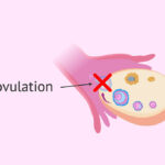 infertility associated with anovulation