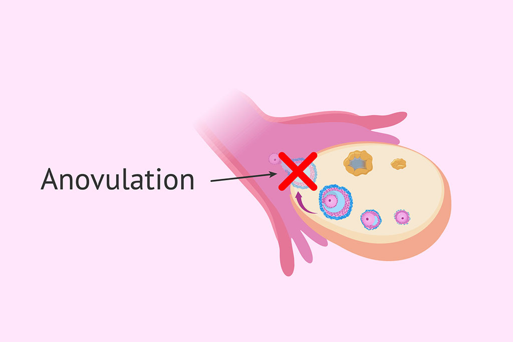 infertility associated with anovulation