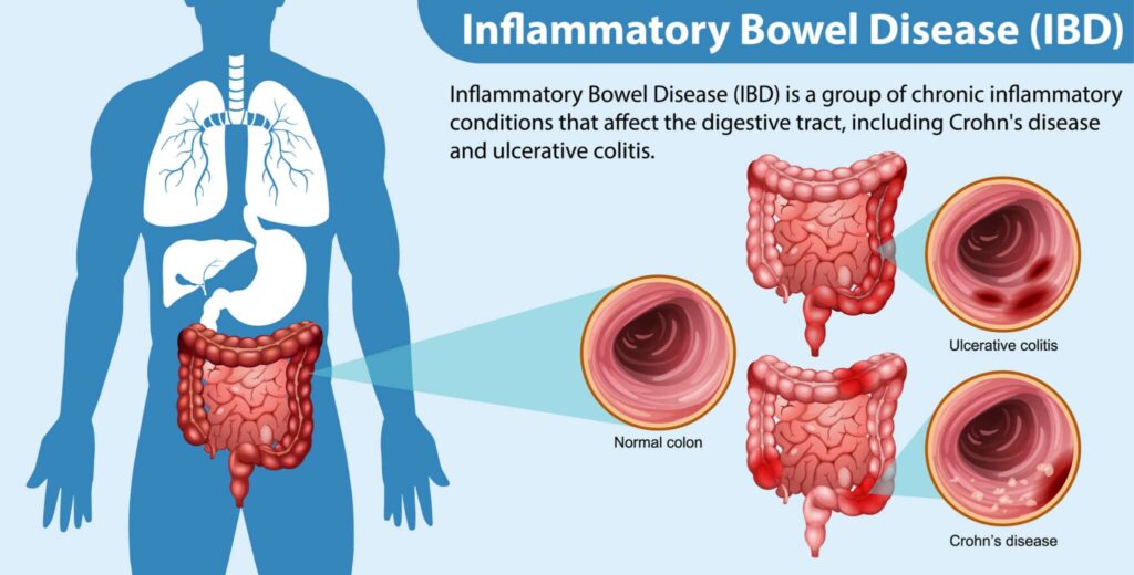 inflammatory bowel disease