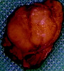 insulinoma