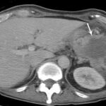 intra abdominal abscess