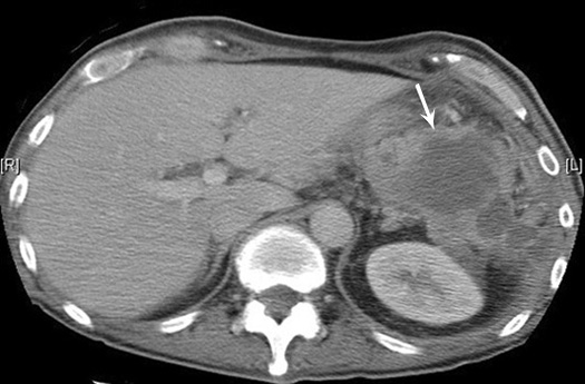 intra abdominal abscess