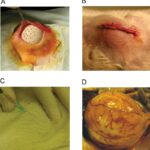 intra abdominal bacteroides abscess