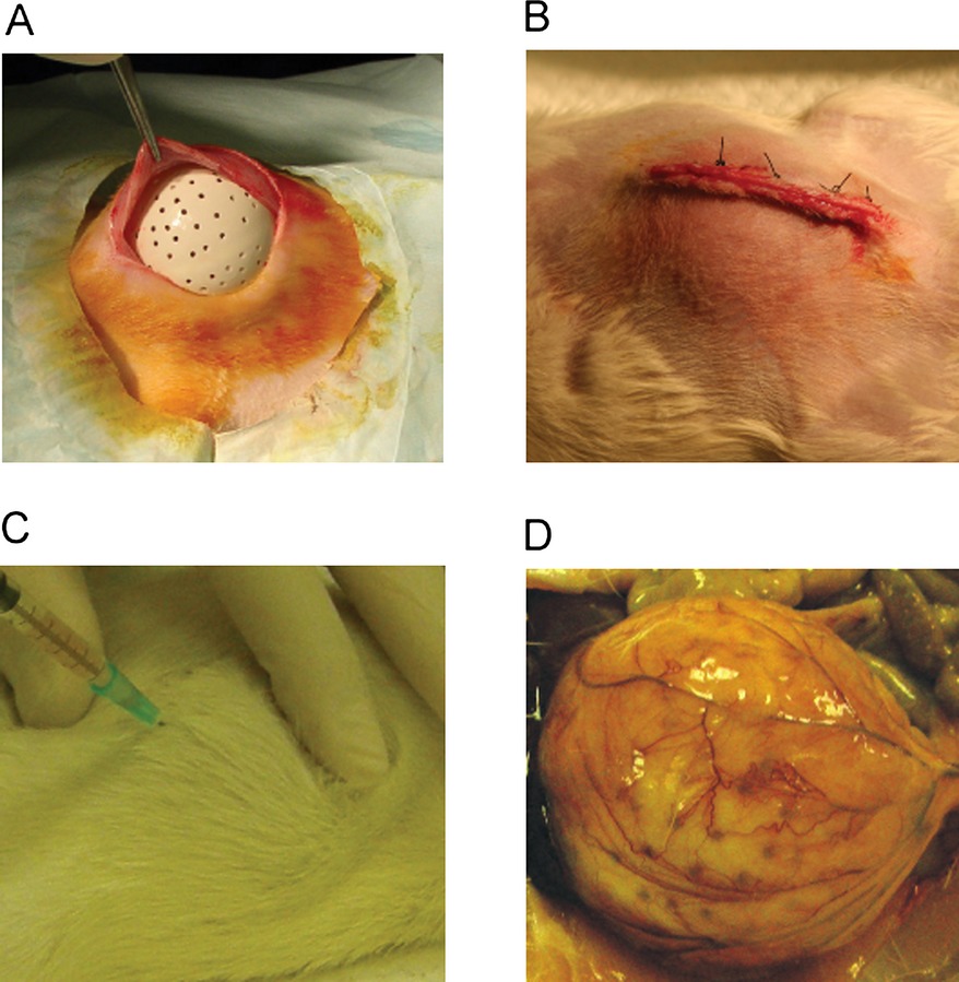 intra abdominal bacteroides abscess