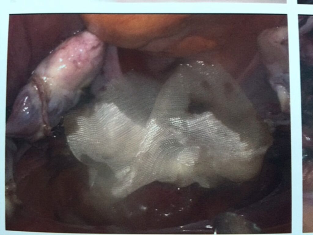 intra abdominal candida abscess