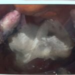 intra abdominal candida abscess