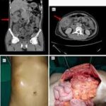 intra abdominal clostridium abscess