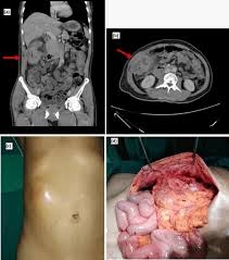 intra abdominal clostridium abscess