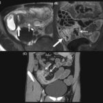 intra abdominal e. coli abscess