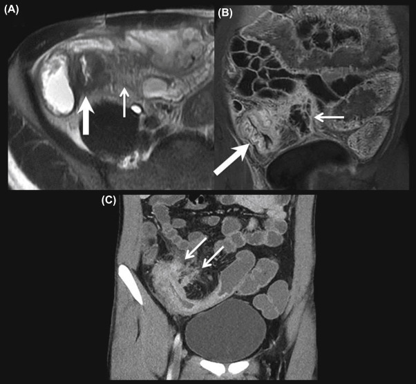 intra abdominal e. coli abscess