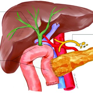 intra abdominal eubacterium abscess