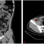 intra abdominal klebsiella abscess